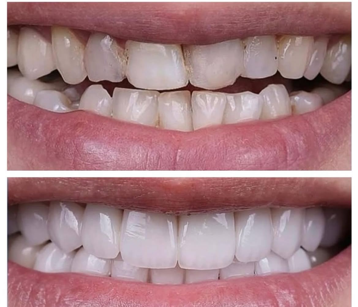 Şeffaf plak ortodonti