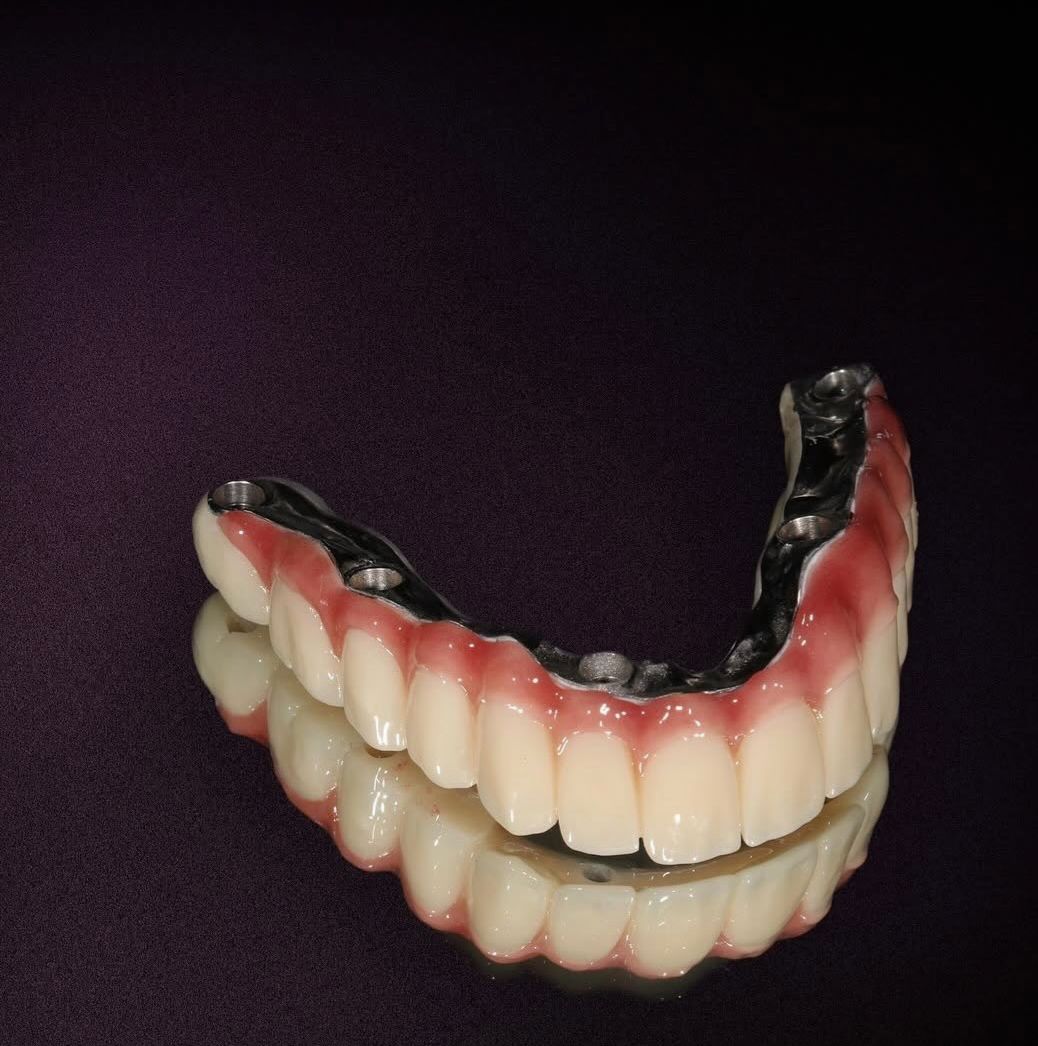 Kompozit bonding uygulaması